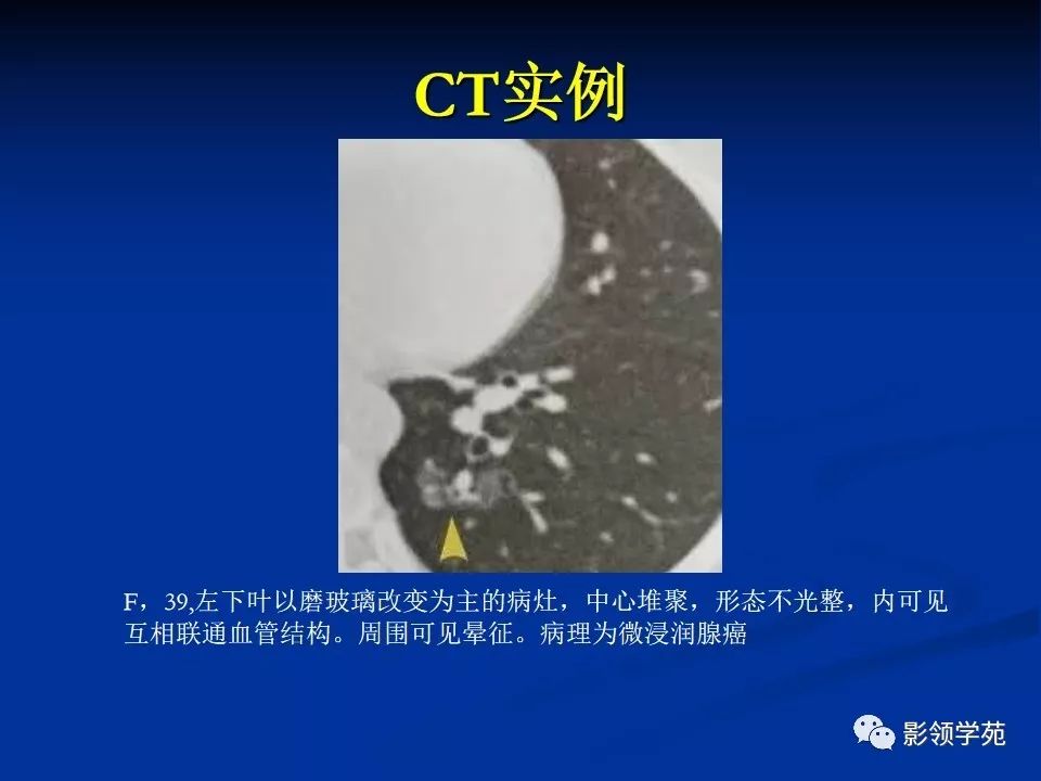 影像PPT - 【PPT】肺腺癌的十类形态学分型-27