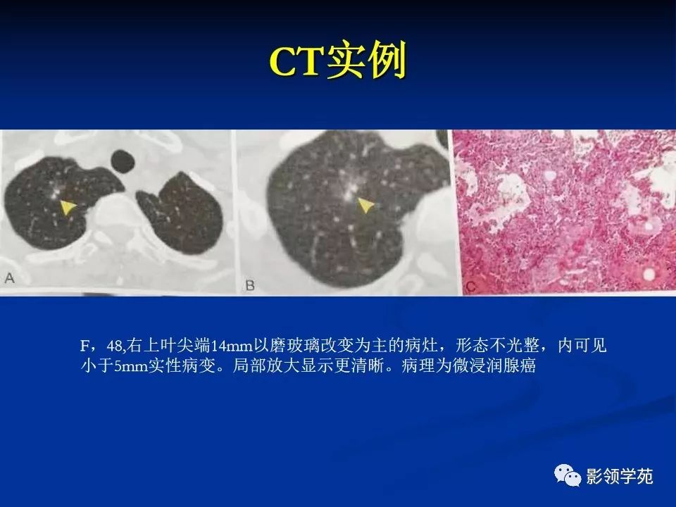 影像PPT - 【PPT】肺腺癌的十类形态学分型-25