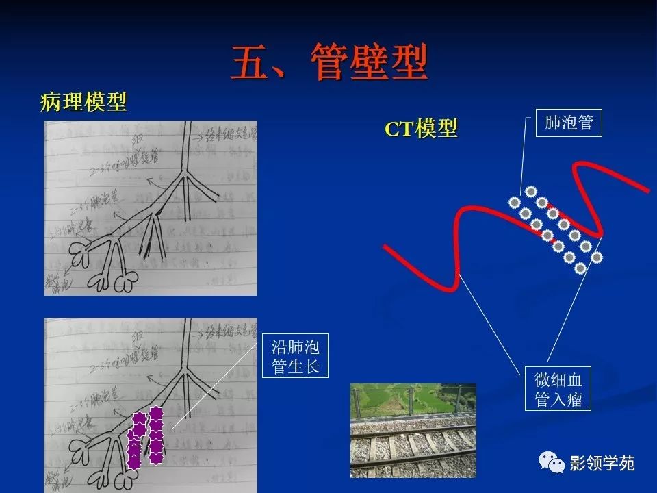 影像PPT - 【PPT】肺腺癌的十类形态学分型-28