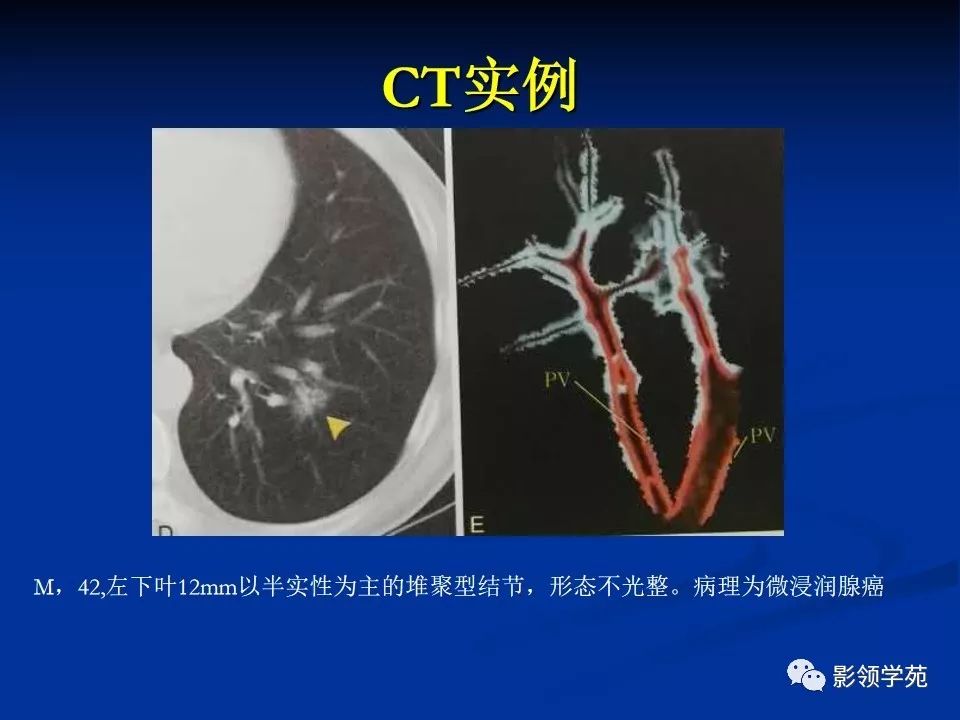 影像PPT - 【PPT】肺腺癌的十类形态学分型-26