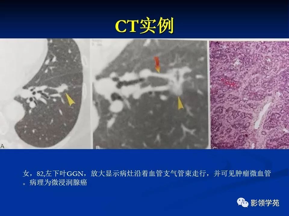 影像PPT - 【PPT】肺腺癌的十类形态学分型-30