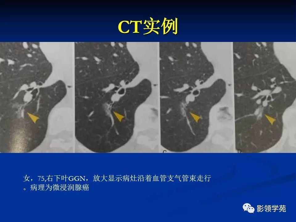 影像PPT - 【PPT】肺腺癌的十类形态学分型-31