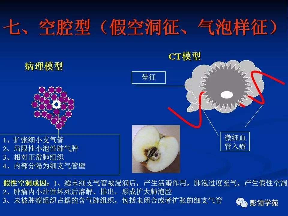 影像PPT - 【PPT】肺腺癌的十类形态学分型-36