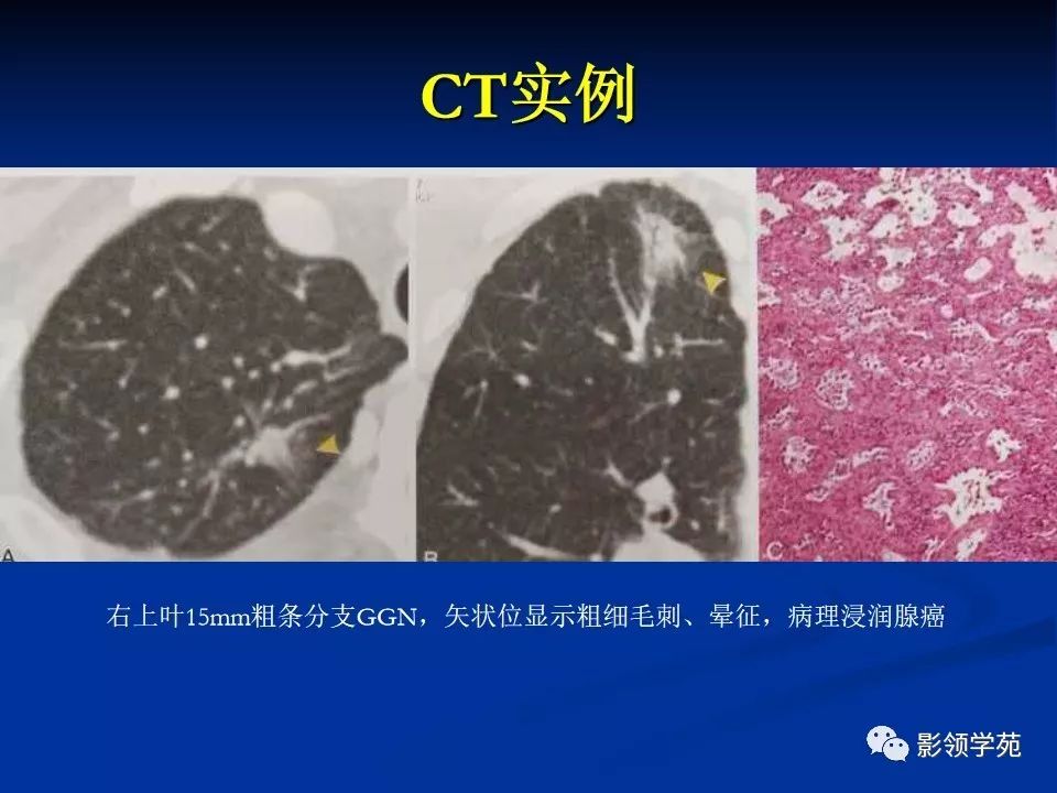 影像PPT - 【PPT】肺腺癌的十类形态学分型-33