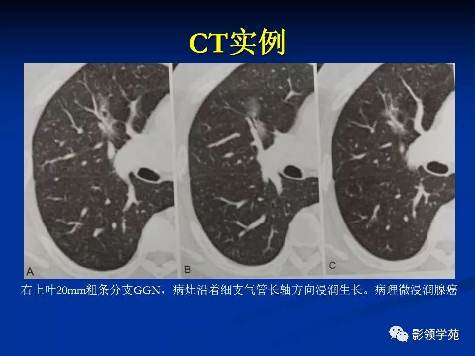 影像PPT - 【PPT】肺腺癌的十类形态学分型-35