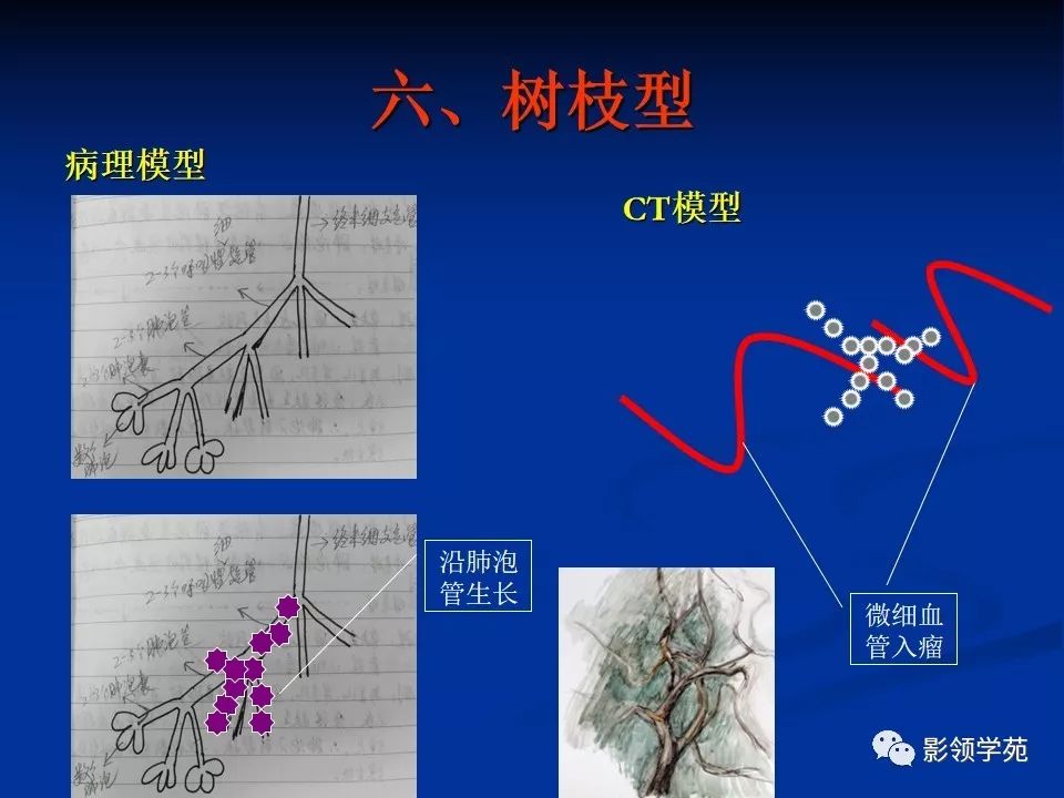 影像PPT - 【PPT】肺腺癌的十类形态学分型-32