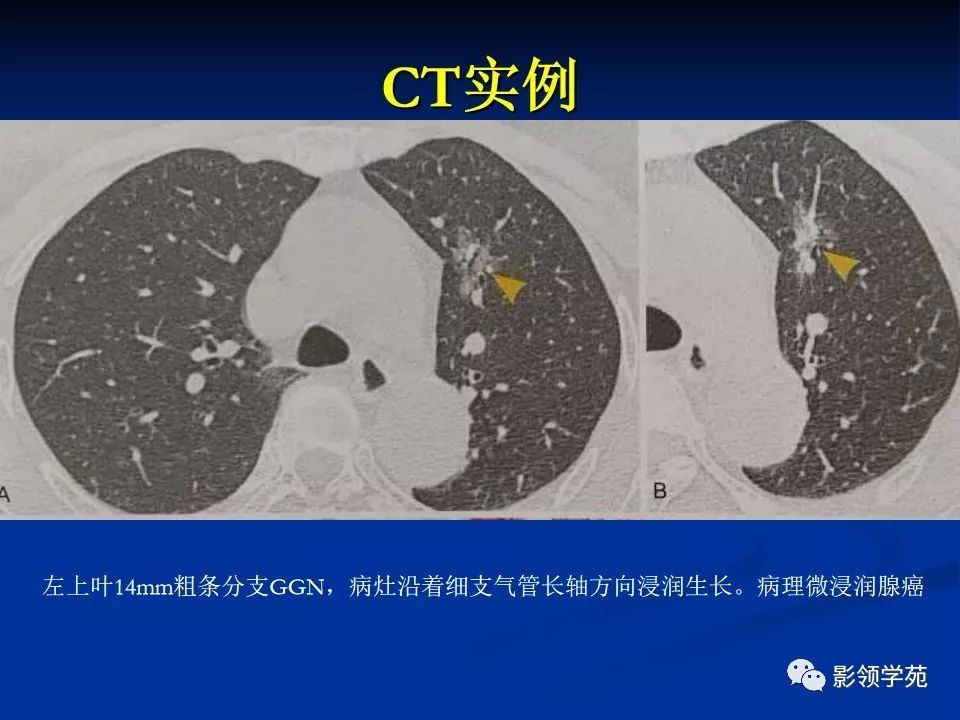 影像PPT - 【PPT】肺腺癌的十类形态学分型-34