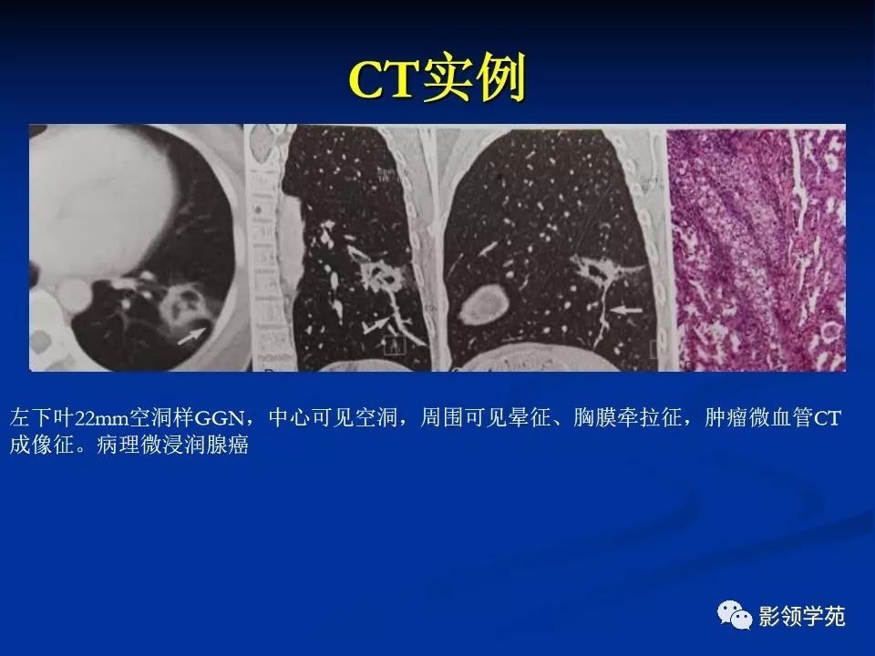 影像PPT - 【PPT】肺腺癌的十类形态学分型-37