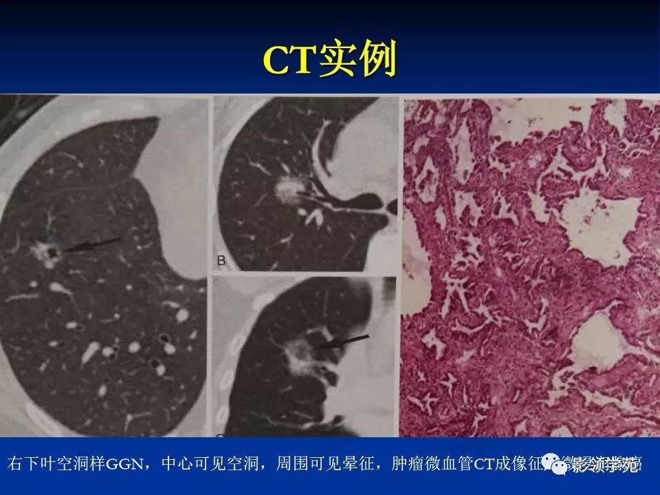 影像PPT - 【PPT】肺腺癌的十类形态学分型-38