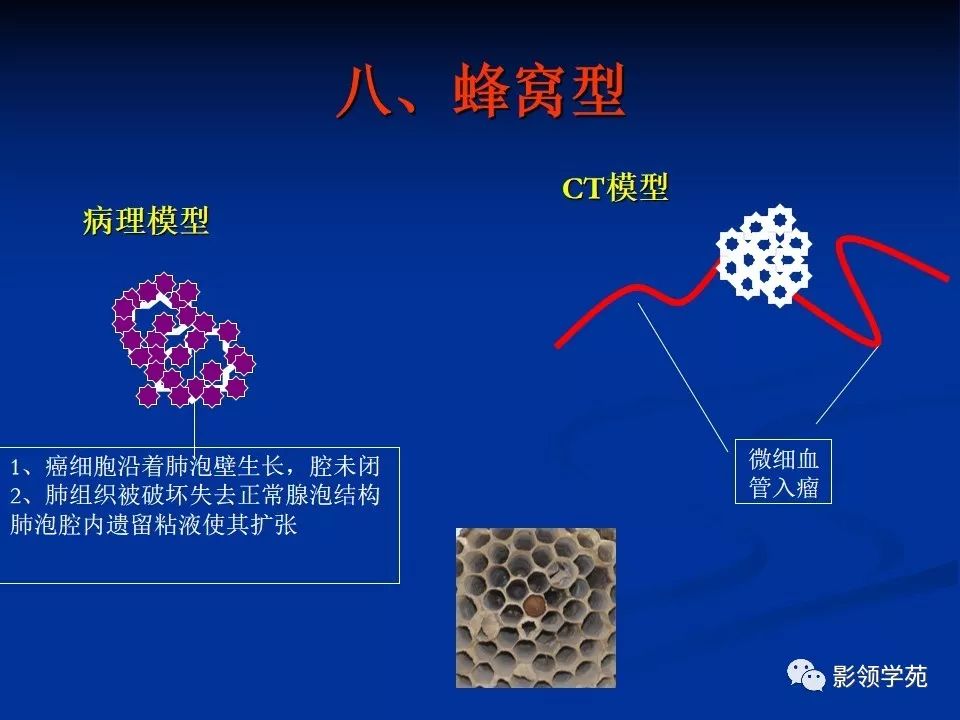影像PPT - 【PPT】肺腺癌的十类形态学分型-39