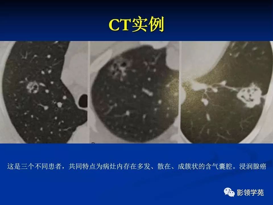 影像PPT - 【PPT】肺腺癌的十类形态学分型-40