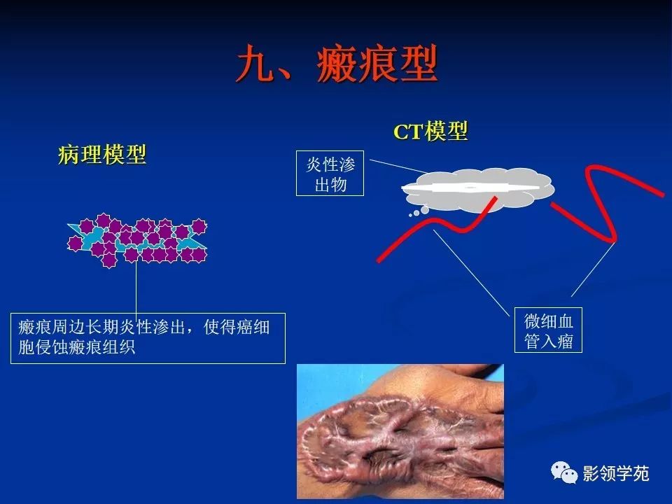 影像PPT - 【PPT】肺腺癌的十类形态学分型-41