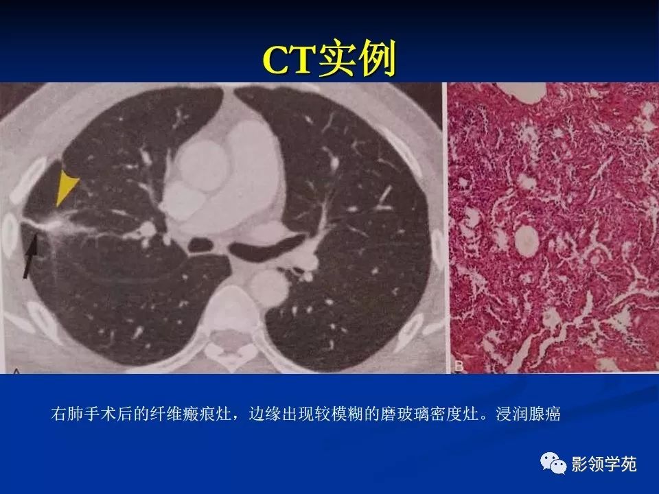 影像PPT - 【PPT】肺腺癌的十类形态学分型-42