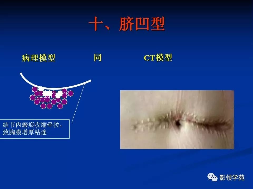 影像PPT - 【PPT】肺腺癌的十类形态学分型-44