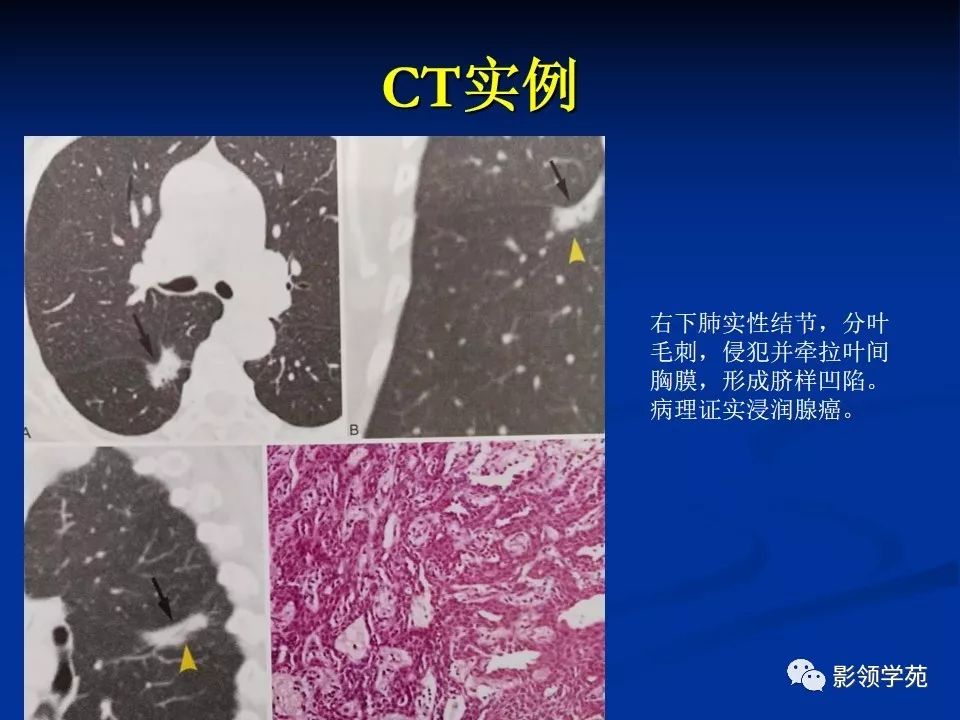 影像PPT - 【PPT】肺腺癌的十类形态学分型-45