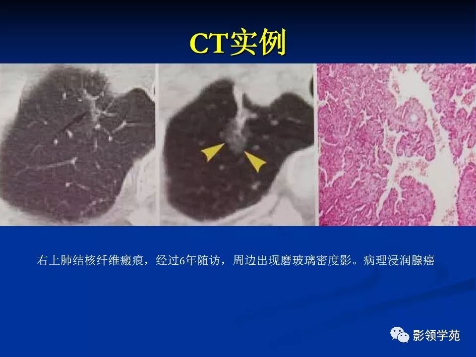 影像PPT - 【PPT】肺腺癌的十类形态学分型-43