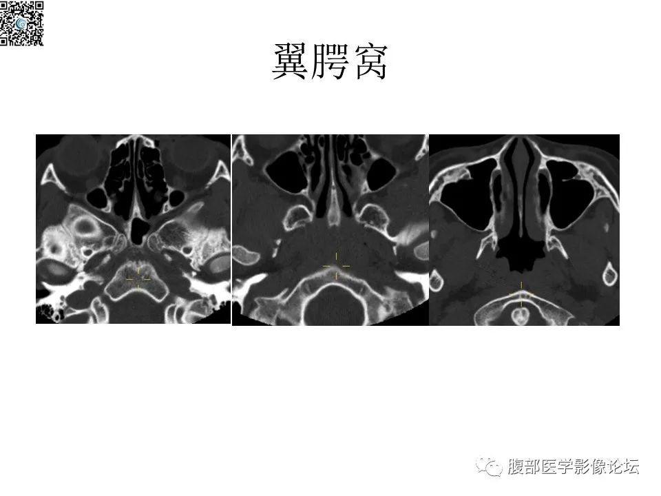 影像PPT - 【PPT】颅骨颅底系列之八面灵通翼腭窝-14