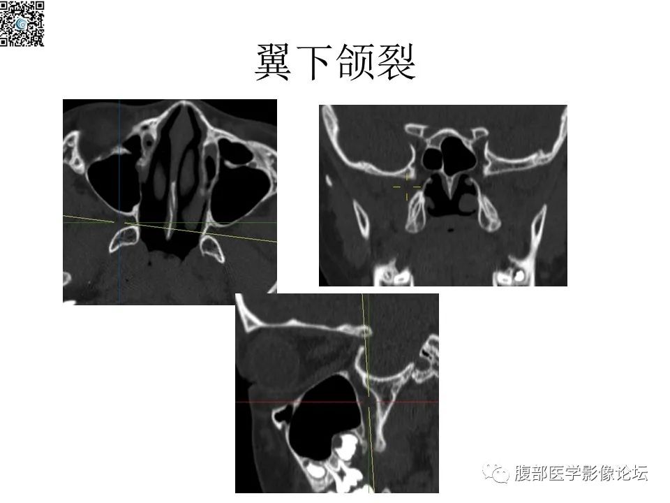 影像PPT - 【PPT】颅骨颅底系列之八面灵通翼腭窝-16