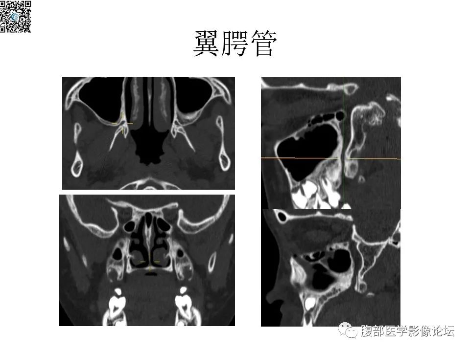 影像PPT - 【PPT】颅骨颅底系列之八面灵通翼腭窝-15