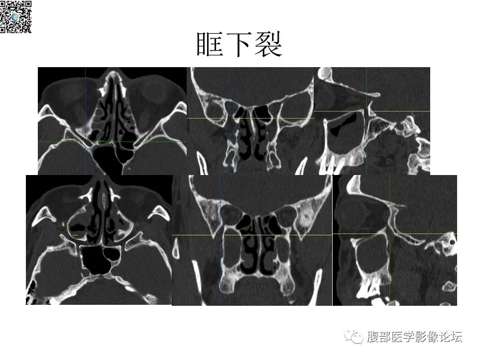 影像PPT - 【PPT】颅骨颅底系列之八面灵通翼腭窝-19