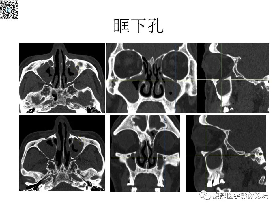 影像PPT - 【PPT】颅骨颅底系列之八面灵通翼腭窝-21