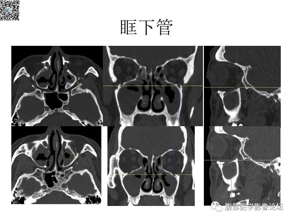 影像PPT - 【PPT】颅骨颅底系列之八面灵通翼腭窝-20