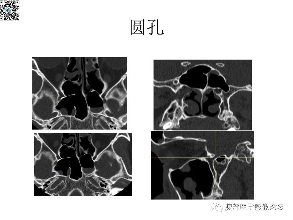 影像PPT - 【PPT】颅骨颅底系列之八面灵通翼腭窝-17