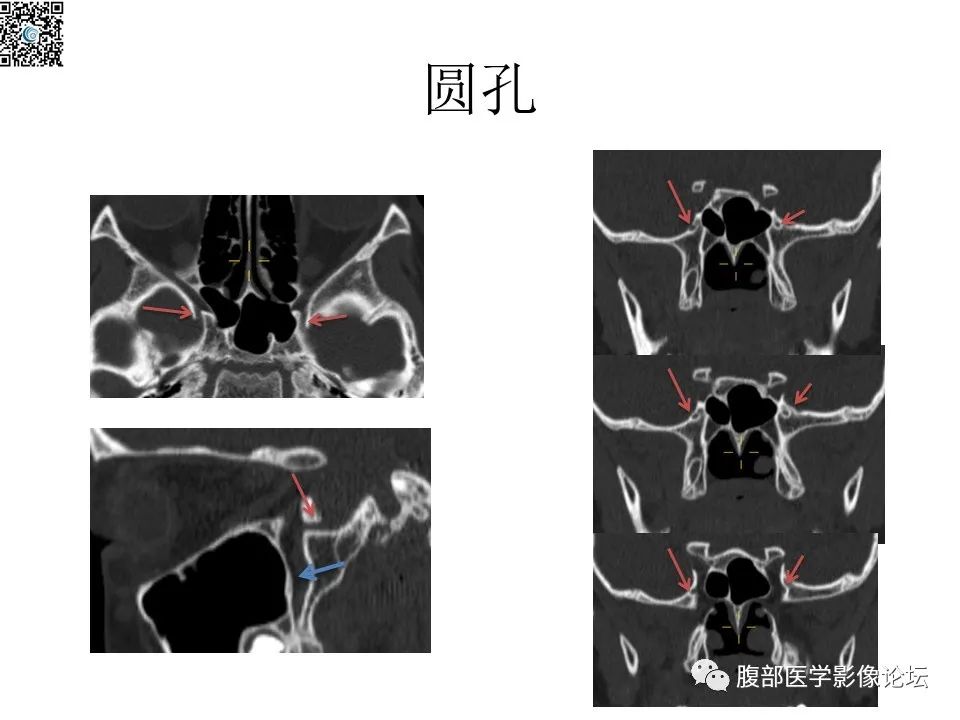 影像PPT - 【PPT】颅骨颅底系列之八面灵通翼腭窝-18