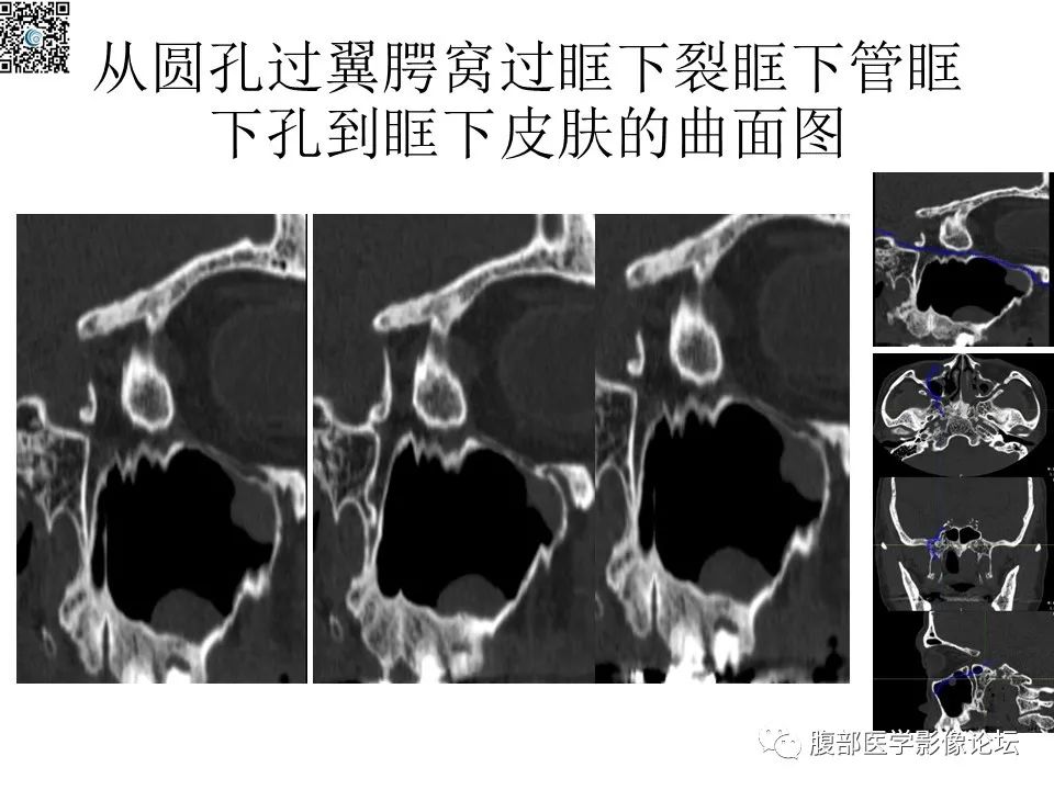 影像PPT - 【PPT】颅骨颅底系列之八面灵通翼腭窝-23