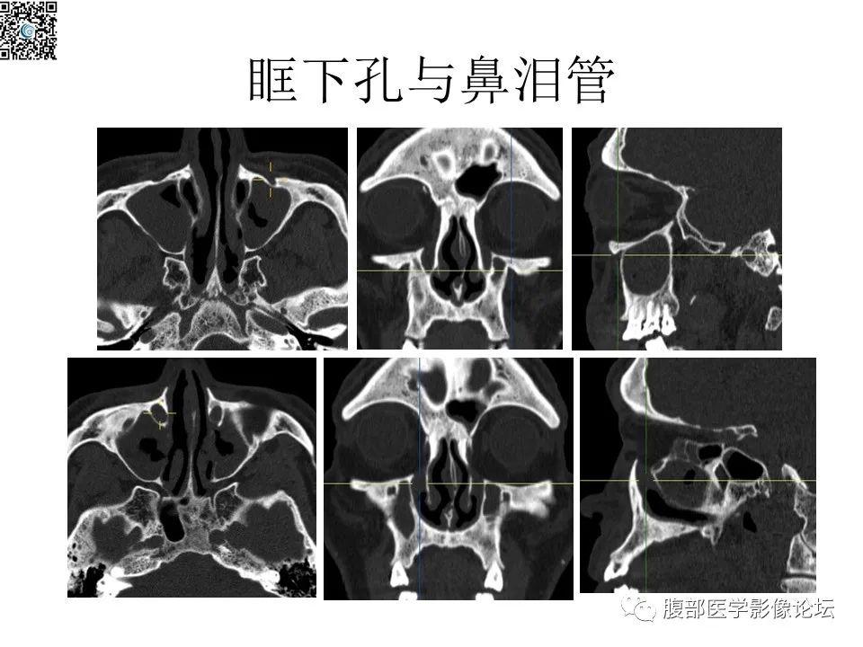 影像PPT - 【PPT】颅骨颅底系列之八面灵通翼腭窝-22