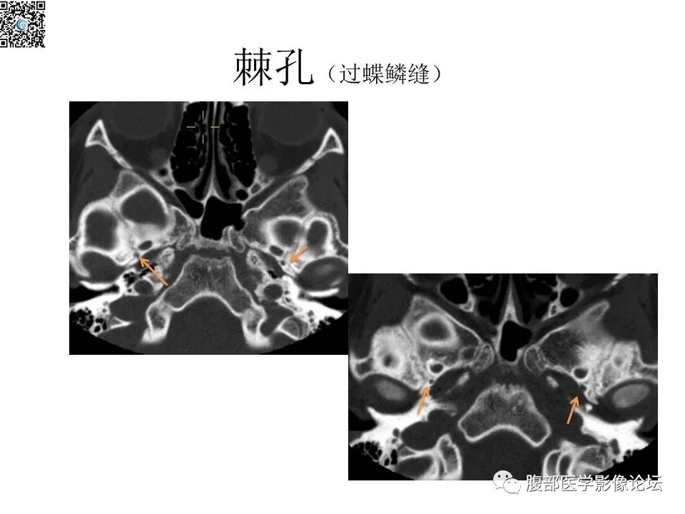影像PPT - 【PPT】颅骨颅底系列之八面灵通翼腭窝-27