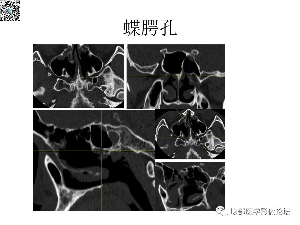 影像PPT - 【PPT】颅骨颅底系列之八面灵通翼腭窝-30