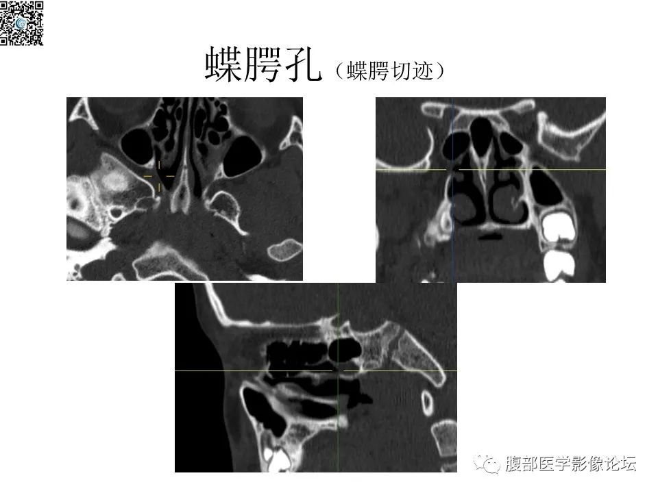 影像PPT - 【PPT】颅骨颅底系列之八面灵通翼腭窝-29