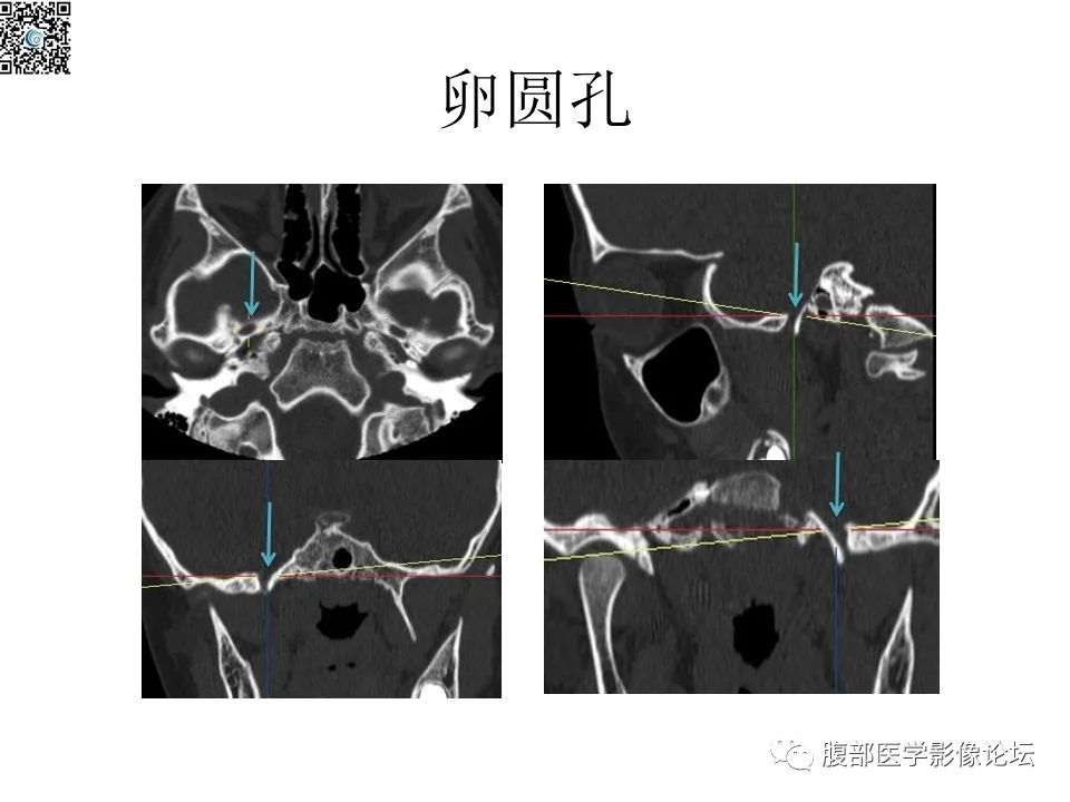 影像PPT - 【PPT】颅骨颅底系列之八面灵通翼腭窝-24