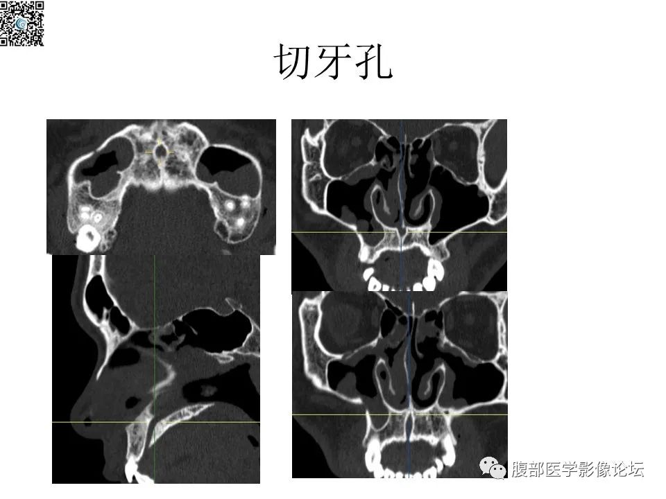 影像PPT - 【PPT】颅骨颅底系列之八面灵通翼腭窝-31