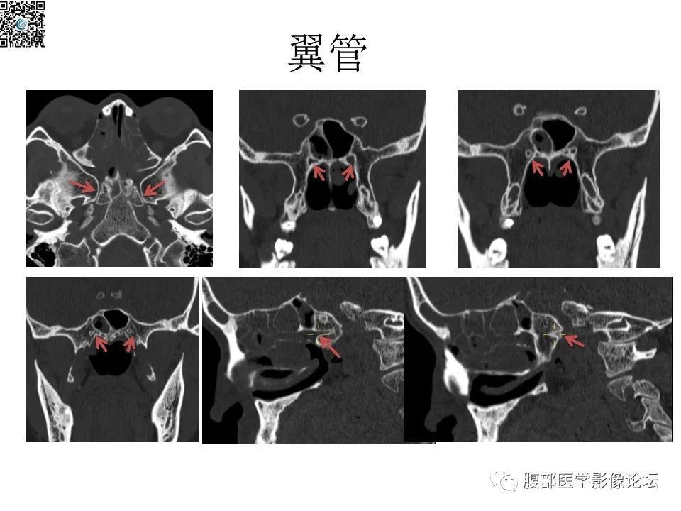 影像PPT - 【PPT】颅骨颅底系列之八面灵通翼腭窝-32