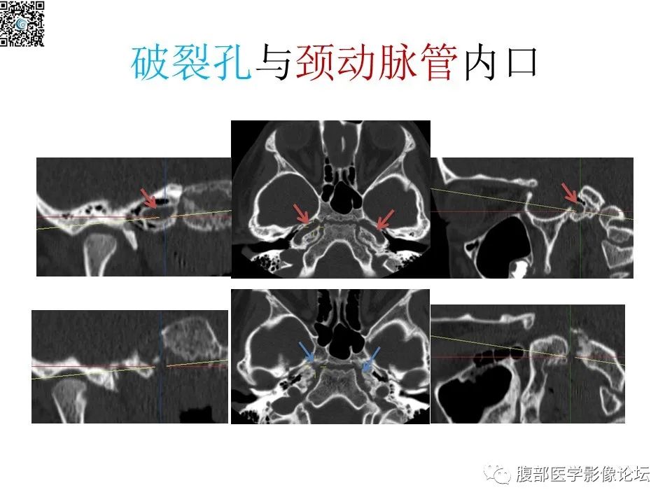影像PPT - 【PPT】颅骨颅底系列之八面灵通翼腭窝-34