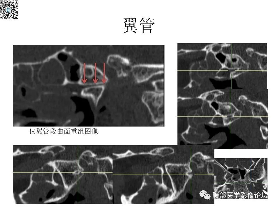影像PPT - 【PPT】颅骨颅底系列之八面灵通翼腭窝-33