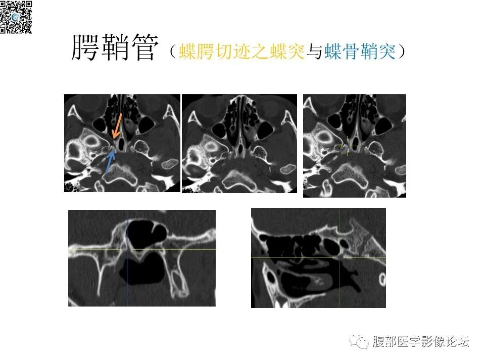 影像PPT - 【PPT】颅骨颅底系列之八面灵通翼腭窝-36