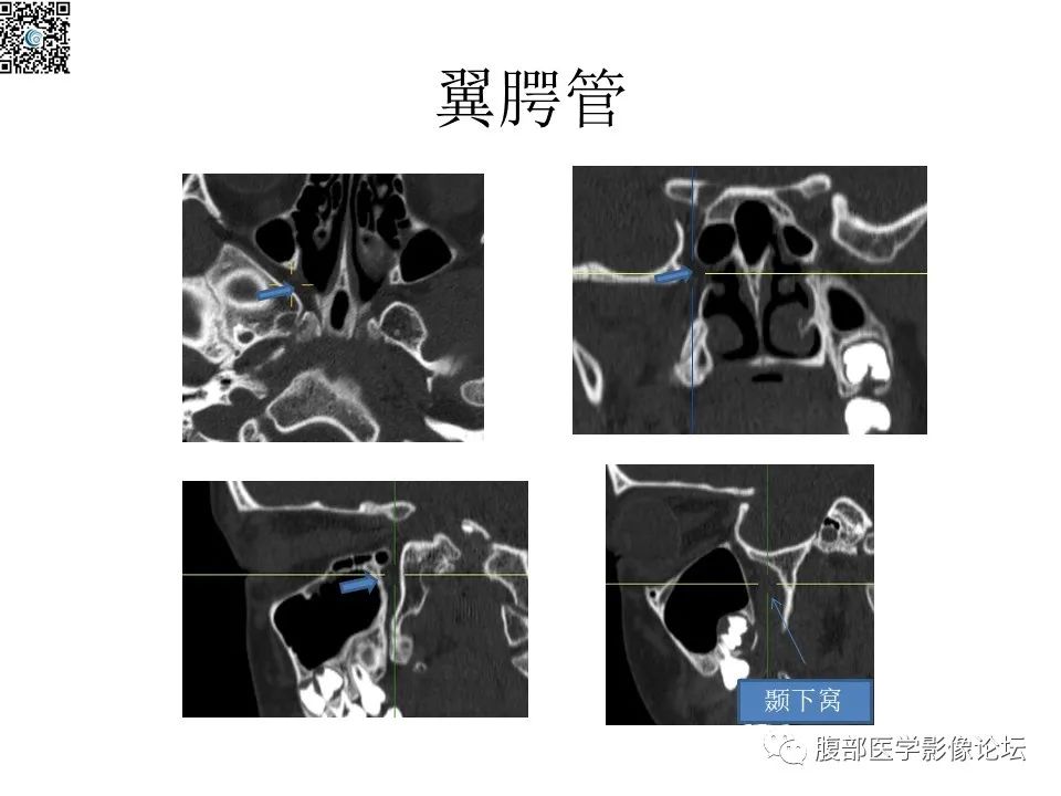 影像PPT - 【PPT】颅骨颅底系列之八面灵通翼腭窝-43