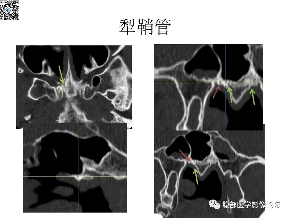 影像PPT - 【PPT】颅骨颅底系列之八面灵通翼腭窝-42