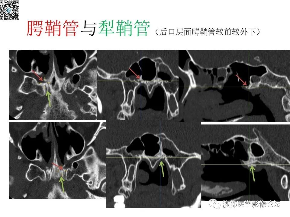 影像PPT - 【PPT】颅骨颅底系列之八面灵通翼腭窝-41