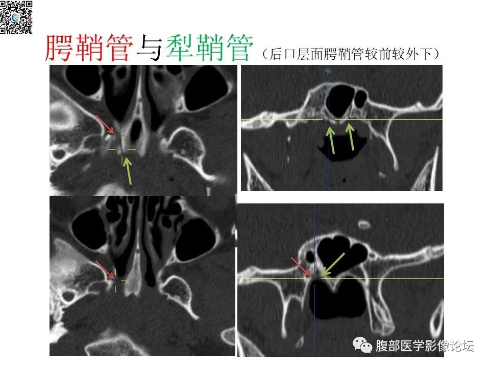 影像PPT - 【PPT】颅骨颅底系列之八面灵通翼腭窝-40