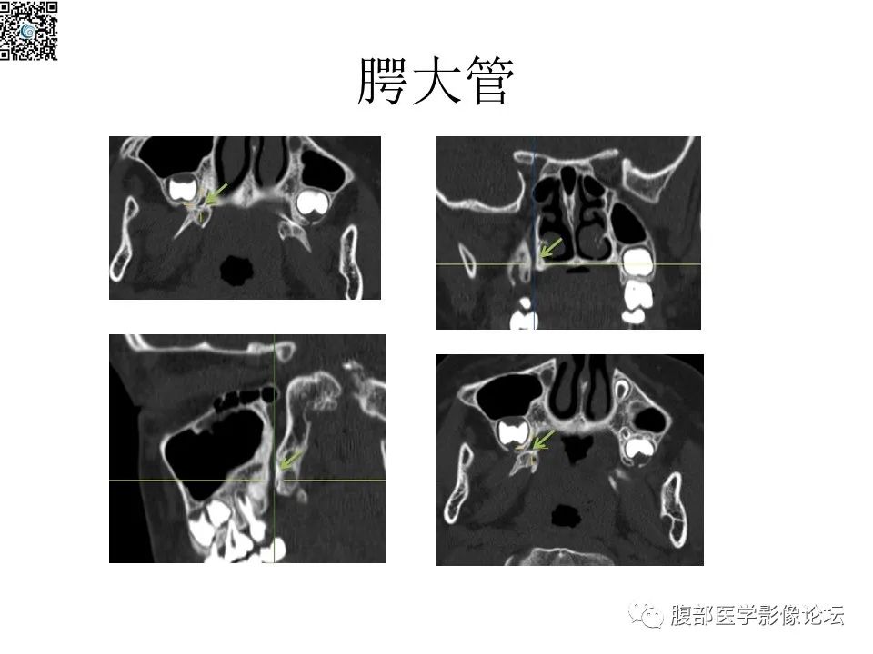 影像PPT - 【PPT】颅骨颅底系列之八面灵通翼腭窝-44