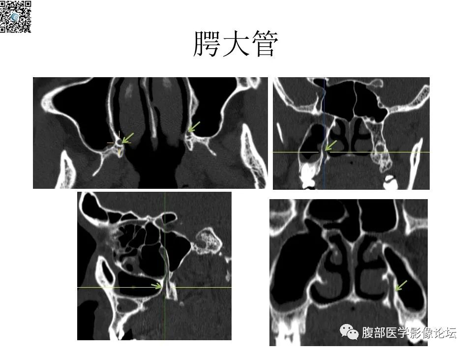 影像PPT - 【PPT】颅骨颅底系列之八面灵通翼腭窝-45