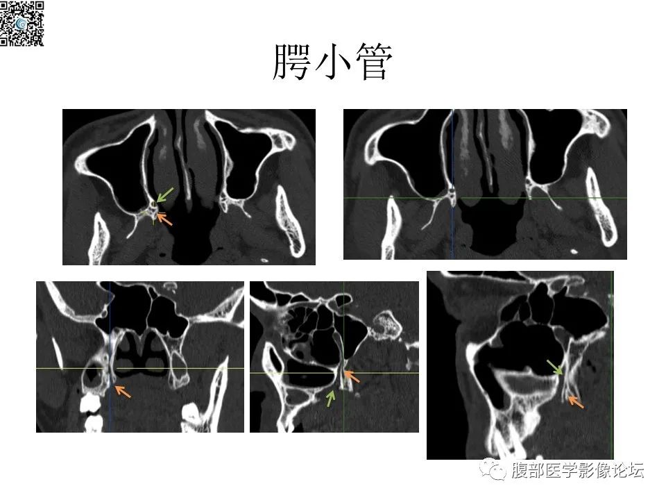 影像PPT - 【PPT】颅骨颅底系列之八面灵通翼腭窝-46