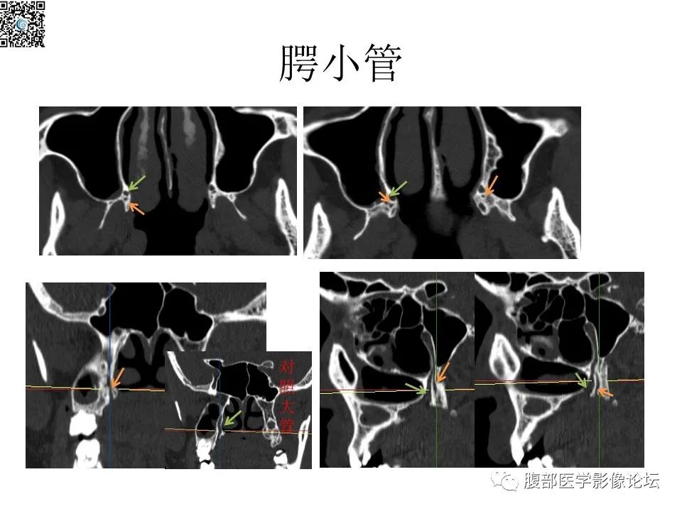 影像PPT - 【PPT】颅骨颅底系列之八面灵通翼腭窝-47