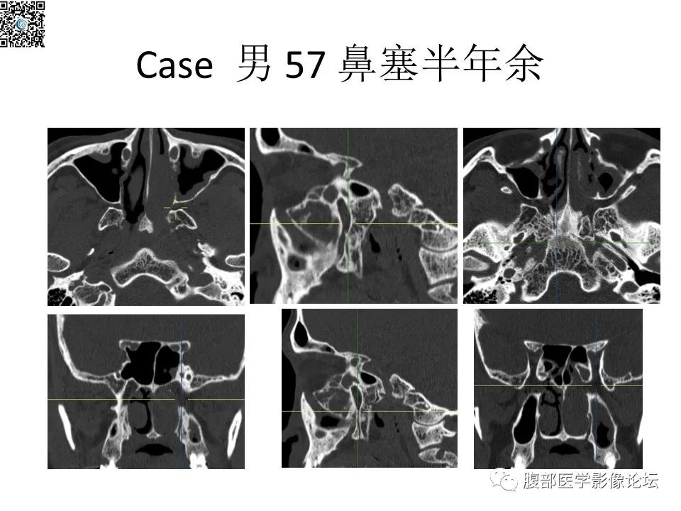 影像PPT - 【PPT】颅骨颅底系列之八面灵通翼腭窝-50
