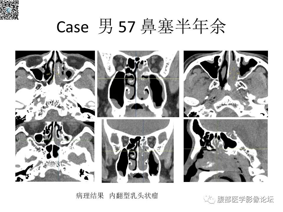 影像PPT - 【PPT】颅骨颅底系列之八面灵通翼腭窝-51