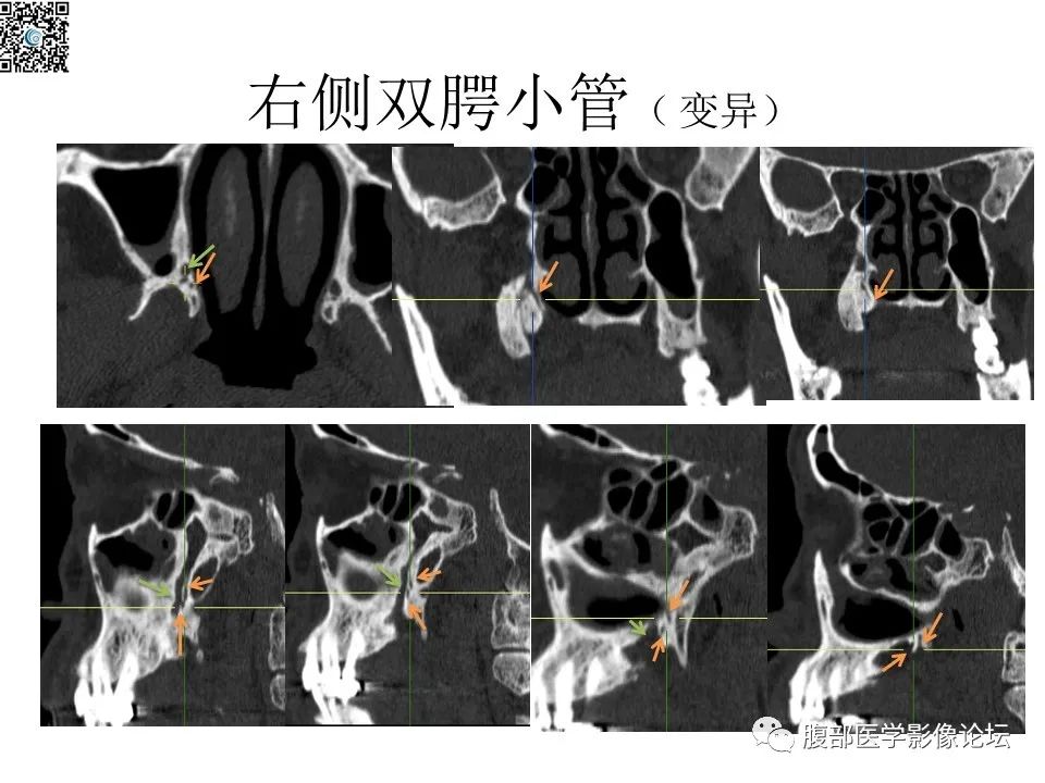 影像PPT - 【PPT】颅骨颅底系列之八面灵通翼腭窝-48